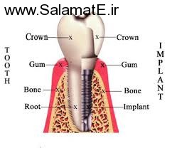 Dental-implants (1)