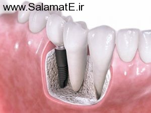 Dental-implants (2)