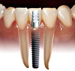 Dental-implants (3)
