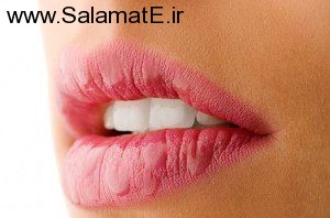 Dry-lips (3)