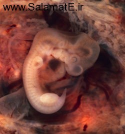 Ectopic-pregnancy (3)