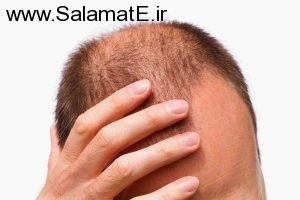hair-loss (3)