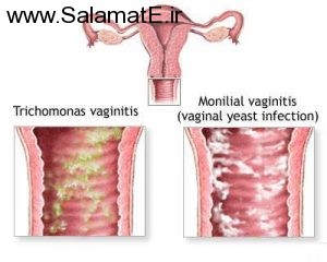 پیشگیری از عفونت قارچی واژن در دوران بارداری
