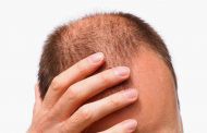 مهمترین دلایل ریزش شدید مو در مردان