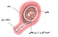 CVS یا نمونه گیری از پرز های جفتی جنین چیست ؟